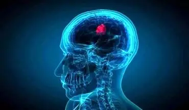 نوآوری در درمان کشنده‌ترین سرطان مغز با یک قطره بینی