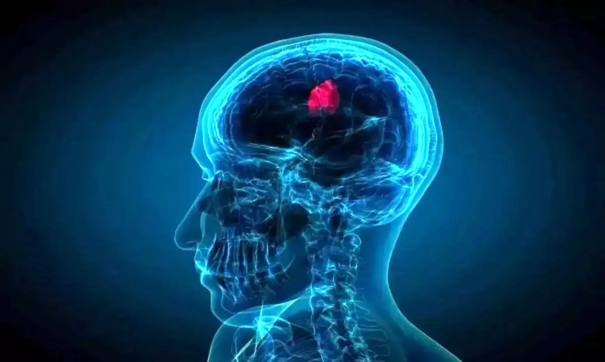 نوآوری در درمان کشنده‌ترین سرطان مغز با یک قطره بینی