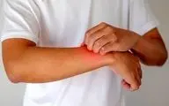 ابزار مؤثر برای کنترل اگزما