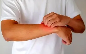 ابزار مؤثر برای کنترل اگزما