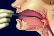 سرطان حنجره؛ بیماری خاموشی که با تغییر صدا هشدار می‌دهد
