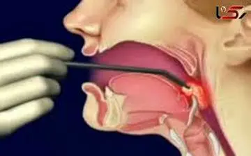 سرطان حنجره؛ بیماری خاموشی که با تغییر صدا هشدار می‌دهد