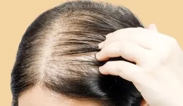 اگر شما هم در حال کچل شدن هستید این مطلب را بخوانید!