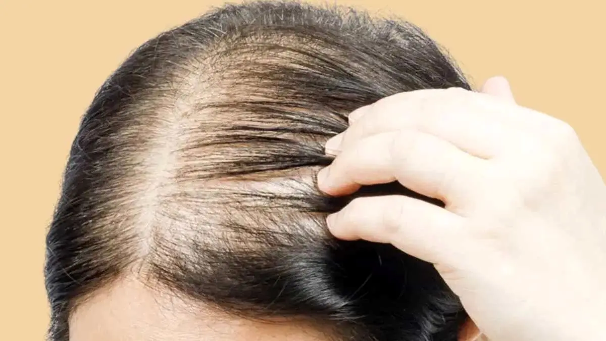 اگر شما هم در حال کچل شدن هستید این مطلب را بخوانید!