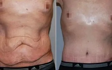 آیا پیکرتراشی برگشت دارد؟