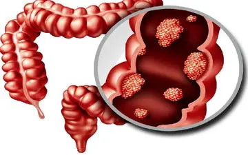 سرطان روده کوچک