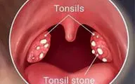 عامل اصلی بوی بد دهان چیست؟!