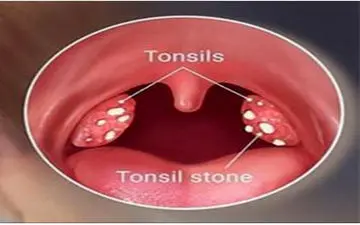 سنگ لوزه عامل اصلی بوی بد دهان!
