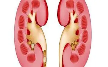 10 ماده غذایی که باعث سنگ کلیه می‌شوند