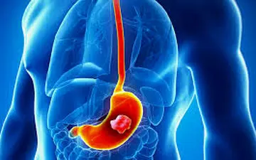 تاثیر نوشیدنی‌های داغ در سرطان معده
