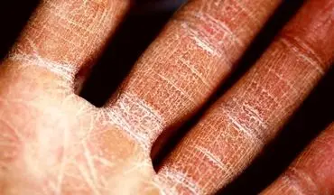 تغییرات اقلیمی، دشمن اگزما؛ آلودگی هوا و دماهای شدید بیماری پوستی را تشدید می‌کنند
