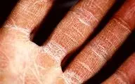 تغییرات اقلیمی، دشمن اگزما؛ آلودگی هوا و دماهای شدید بیماری پوستی را تشدید می‌کنند
