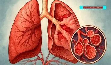 سندرم دیسترس تنفسی حاد؛ وقتی ریه‌ها ناگهان از کار می‌افتند