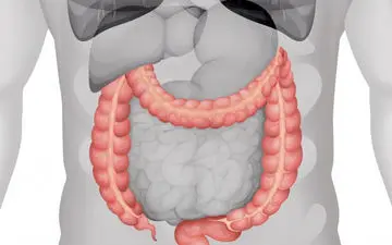 بیماری پولیپ هایپرپلاستیک (پلاستیک) چیست؟