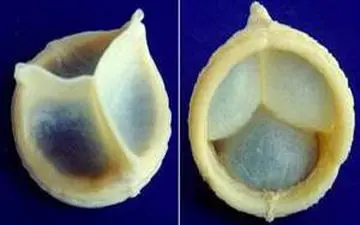 در این مطلب می‌خوانیم که بیماری دریچه قلب چیست و چطور کنترل می‌شود؟