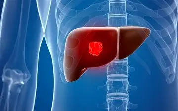درمانی جدید برای سرطان کبد 