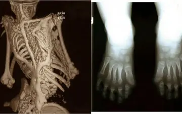 ماجرای بیماری عجیب نوزاد/ او در حال تبدیل شدن به سنگ است