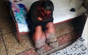 پشه ای که روزگار مرد پاکستانی را سیاه کرد +فیلم 