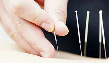 تلاش چین برای صدور طب سنتی خود + فیلم 
