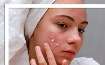 چند ماده غذایی که اکنه را فعال می‌کند