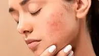 آیا جوش‌ صورت واگیردار است؟