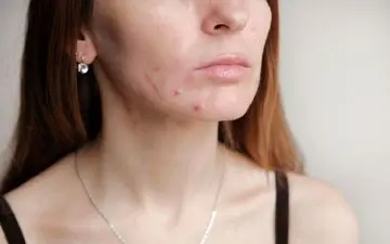 ۶ دلیل پنهان پشت جوش‌های بزرگسالی
