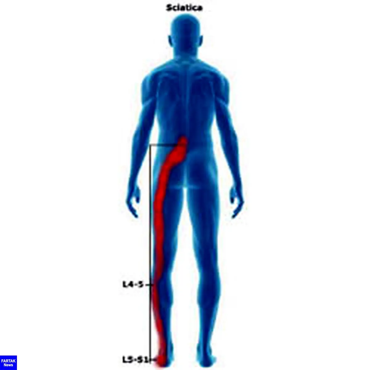 سیاتیک اذیتت میکنه؟ بیا تا درمان سه سوته را نشونت بدم!