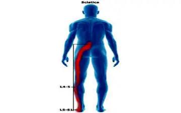 سیاتیک اذیتت میکنه؟ بیا تا درمان سه سوته را نشونت بدم!