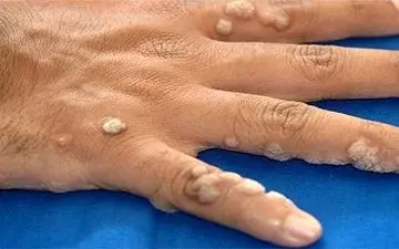 زگیل خطر ابتلا به سرطان دهان و لوزه را افزایش می دهد