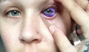 عاقبت دردناک دختر جوان پس از رنگ کردن سفیدی چشمانش