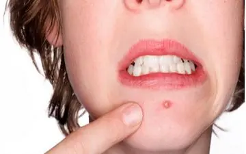 آکنه می‌تواند ناشی از بی‌تعادلیِ باکتری‌های پوست باشد