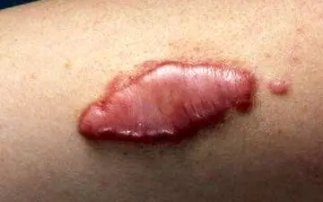 9 درمان برای اسکار کلوئید