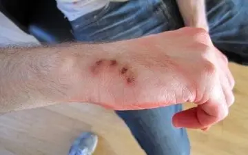 ۲ نفر در البرز بر اثر حیوان‌گزیدگی به کام مرگ رفتند

