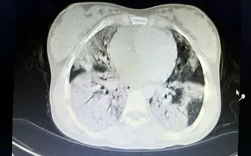 نجات جان مادر باردار با 80 درصد درگیری ریه در زنجان/ بیمار واکسن کرونا تزریق نکرده است