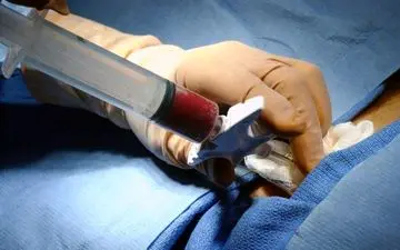 انجام اولین پیوند مغز استخوان اطفال از غیر برای اولین بار در کرمانشاه
