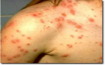 آبله مرغان در کودکان| علل و عوارض آبله در کودکان