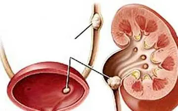چگونه از سنگ کلیه پیشگیری کنیم؟ 