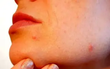 راهی برای خلاصی از شر آکنه‌ها