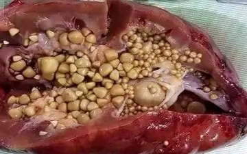 سنگ کلیه چه نشانه‌هایی دارد؟