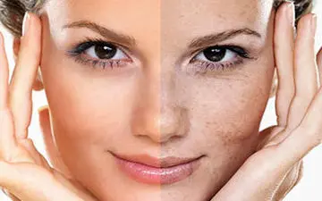 روی بدنت لک‌های پوستی داره؟ بیا تا بهت بگم چطوری برشون داری!