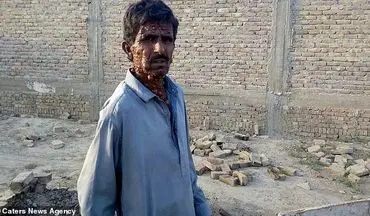 بیماری وحشتناک مرد جوان پاکستانی سوژه رسانه ها شد+ فیلم 
