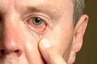 آیا شما هم این علائم را در چشم‌هایتان دارید؟ خطر کلسترول بالا را جدی بگیرید!