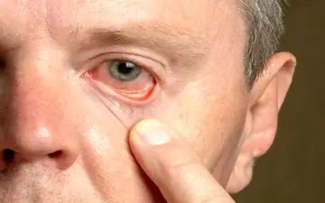 آیا شما هم این علائم را در چشم‌هایتان دارید؟ خطر کلسترول بالا را جدی بگیرید!