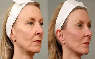 بهترین زمان برای جراحی لیفت صورت و گردن کی است؟
