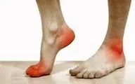 برای درمان آرتروز مچ پا چکار کنیم؟