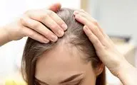  بایدها و نبایدهای مقابله با ریزش مو
