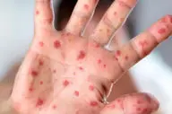 مراقب این بیماری باشید!

