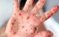مراقب این بیماری باشید!

