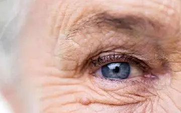پیر چشمی چه علائمی دارد؟