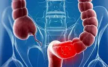 عوامل خطرساز سرطان روده